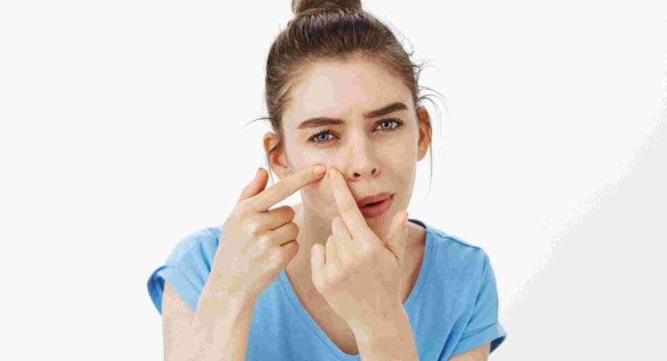 acne removal cream for oily skin